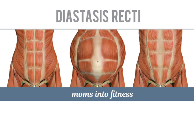 Diastasis Recti Do S Don Ts During Pregnancy Two