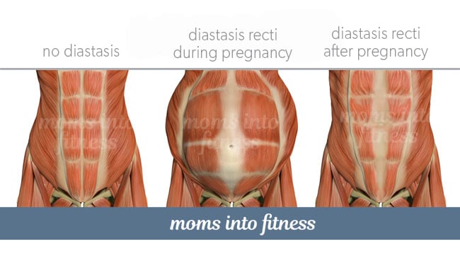 Diastasis Recti Do S Don Ts During Pregnancy Two Specific