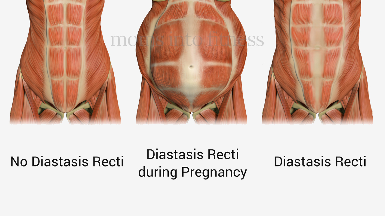 Running with Diastasis Recti - How to Run Safely - Moms Into Fitness