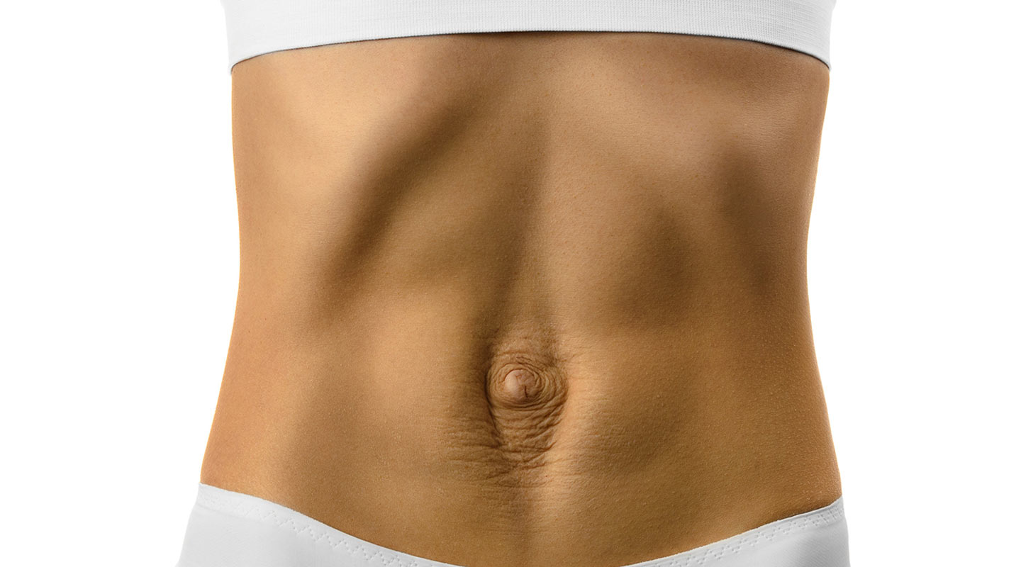 Woman With Diastasis Recti